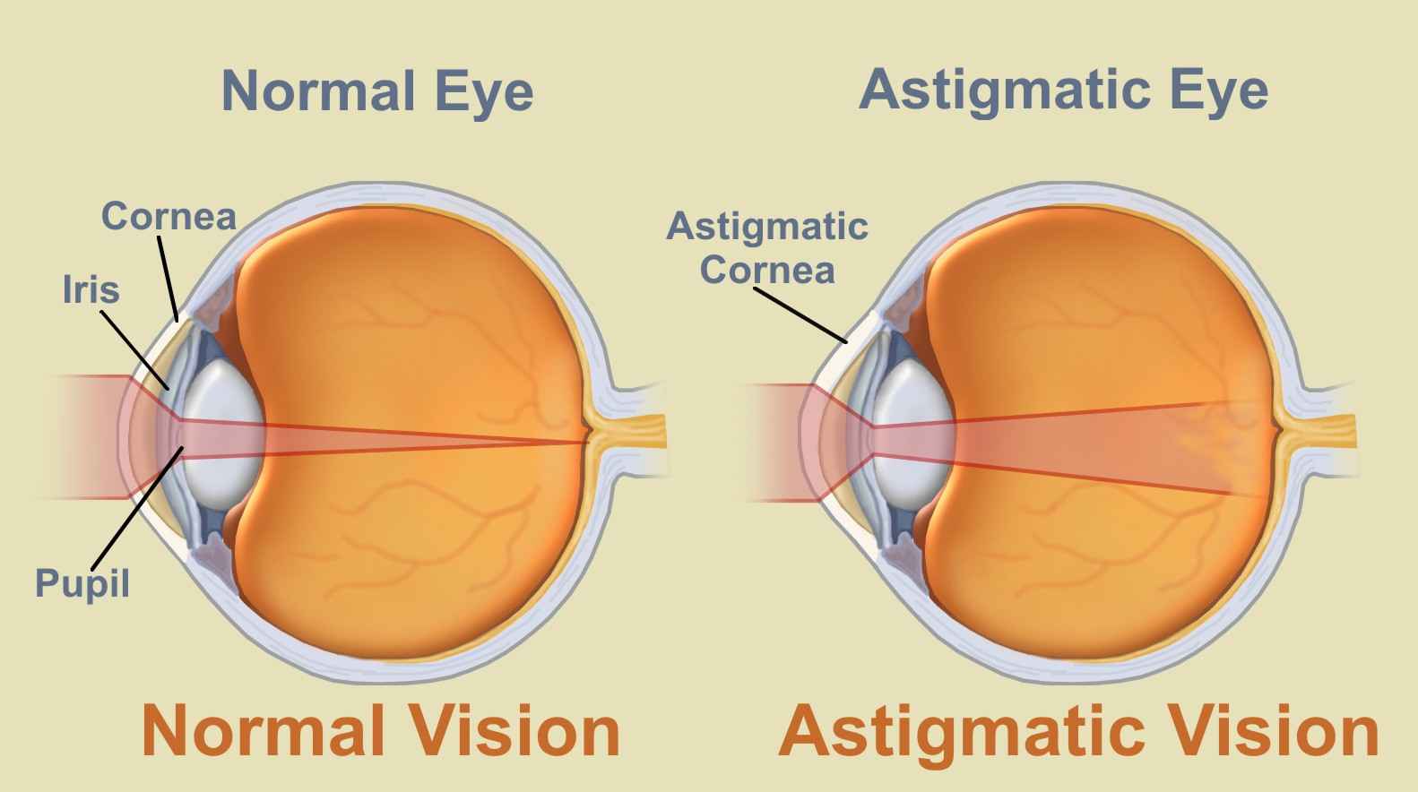 asztigmatizmus szem myopia